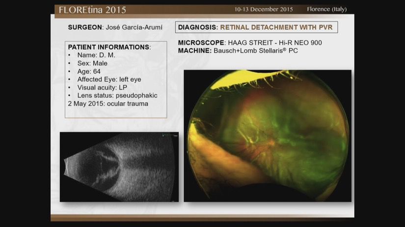 Retinal Detachment With PVR