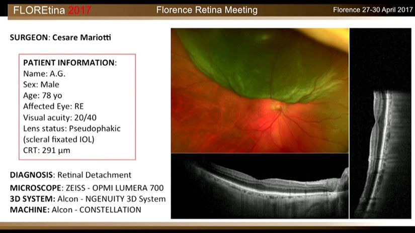 Retinal Detachment