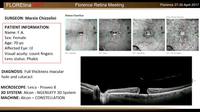 Full Thickness Macular Hole And Cataract