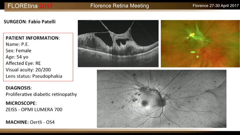 Proliferative Diabetic Retinopathy