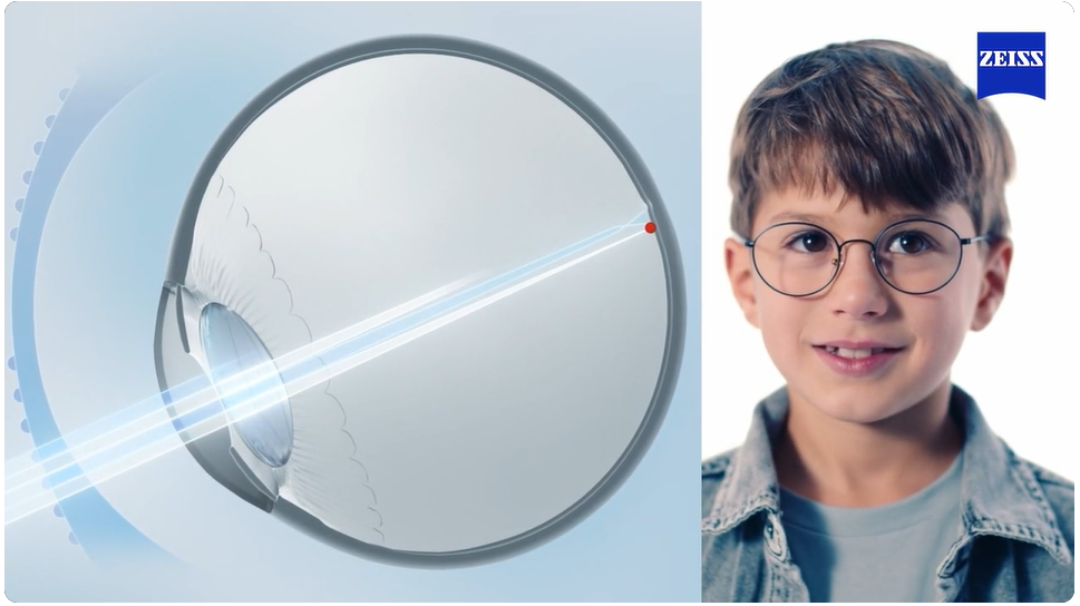 ZEISS MyoCare lenses: updating progress